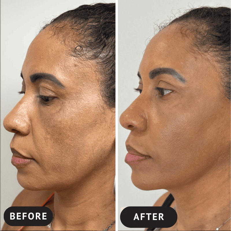 CollagenSkin™ – Anti-Ageing Lifting Mask
